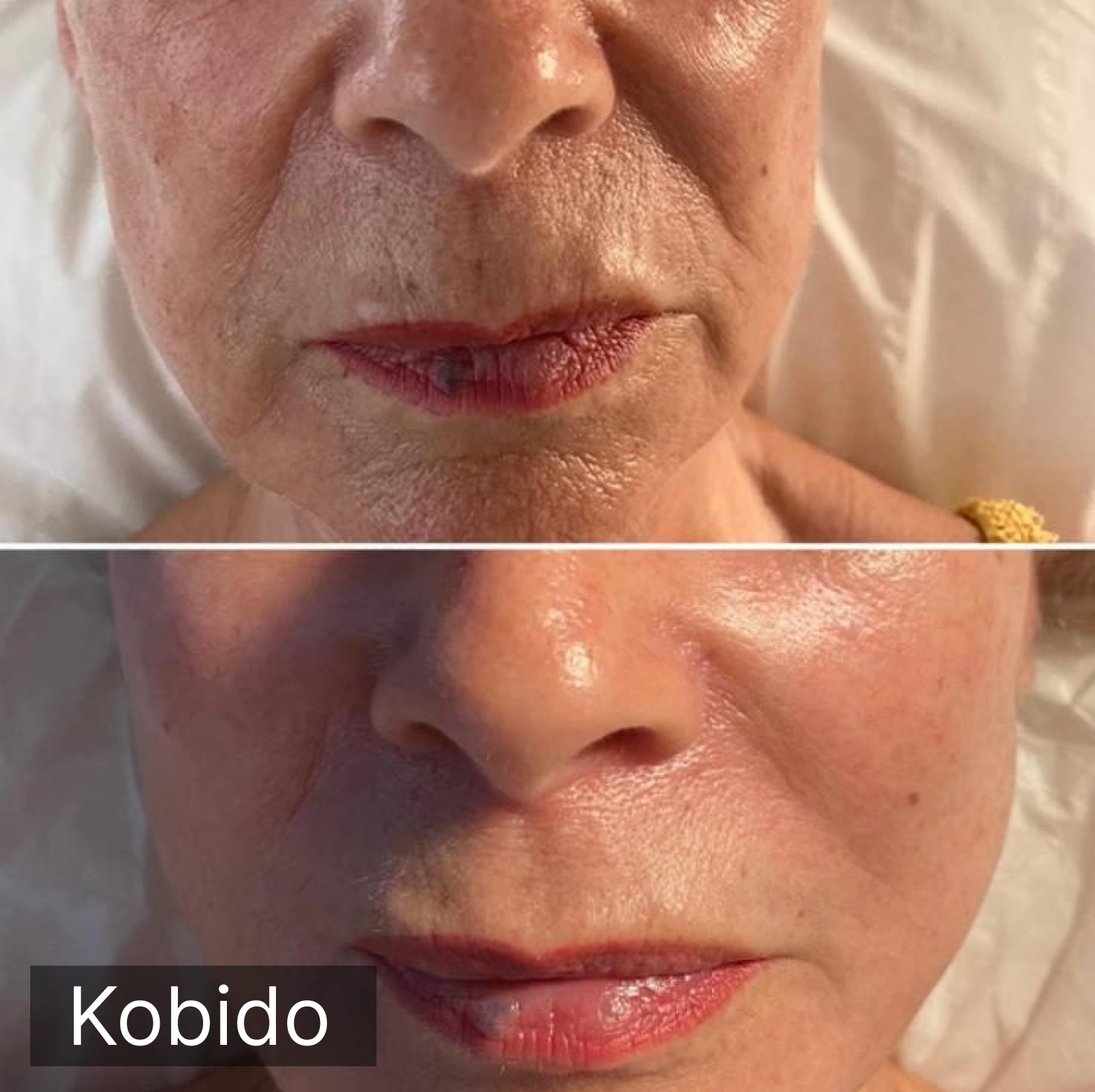 Modelage Kobido avant / après