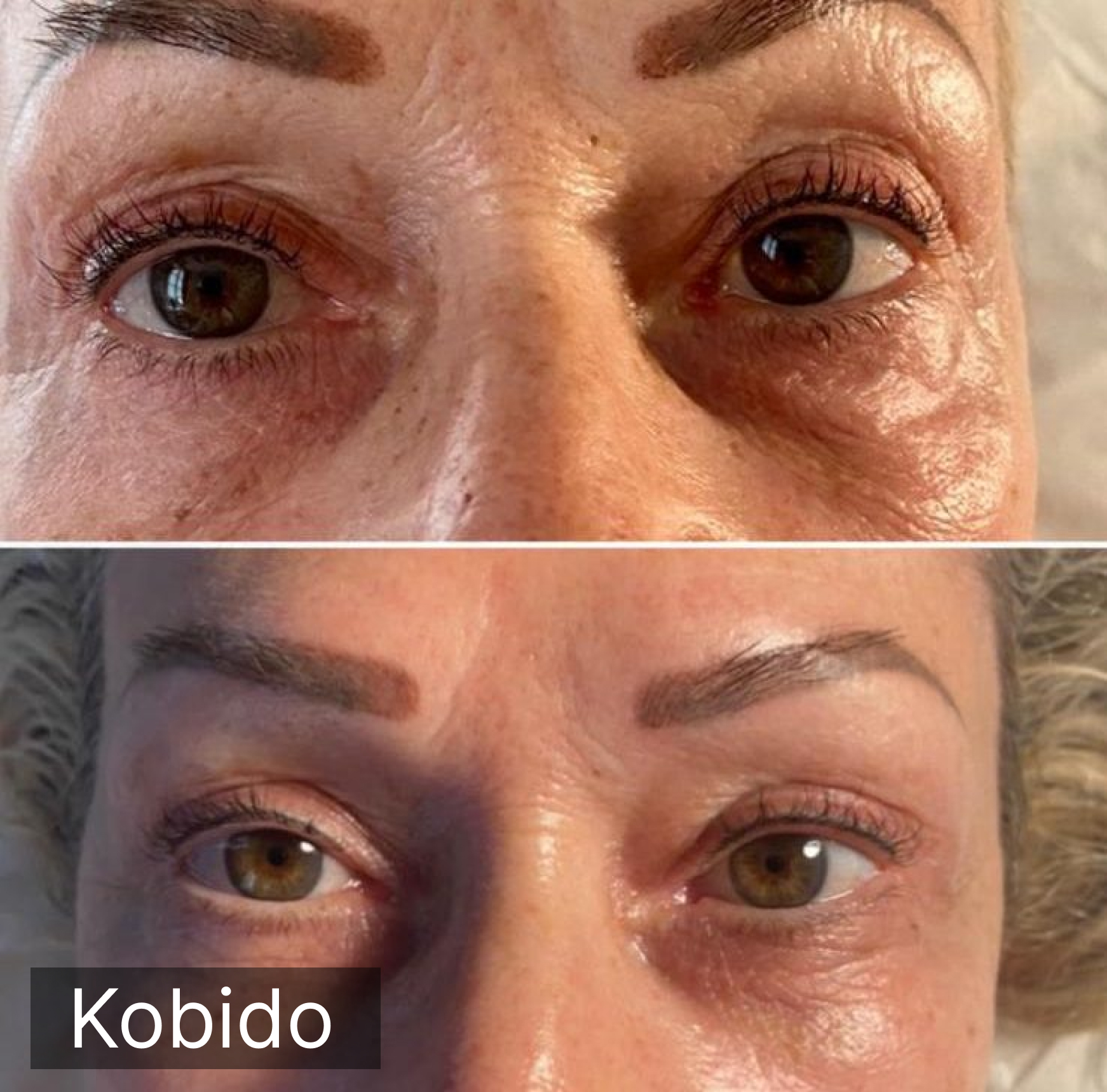 Lifting naturel Kobido